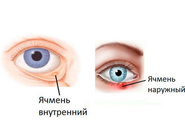 Какие виды ячменя на глазу существуют
