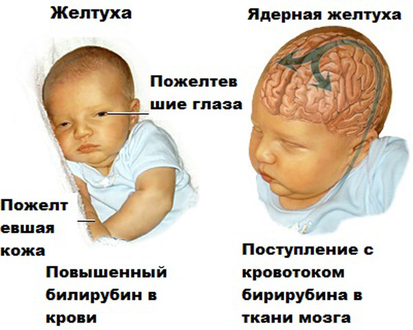 Желтушка у новорожденных: причины, симптомы и лечение