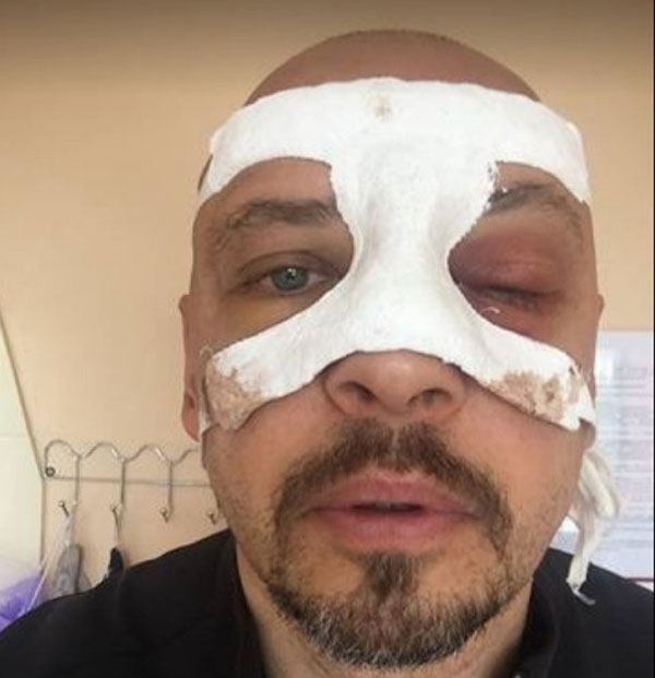 После аварии артисту сделали операцию на глазах