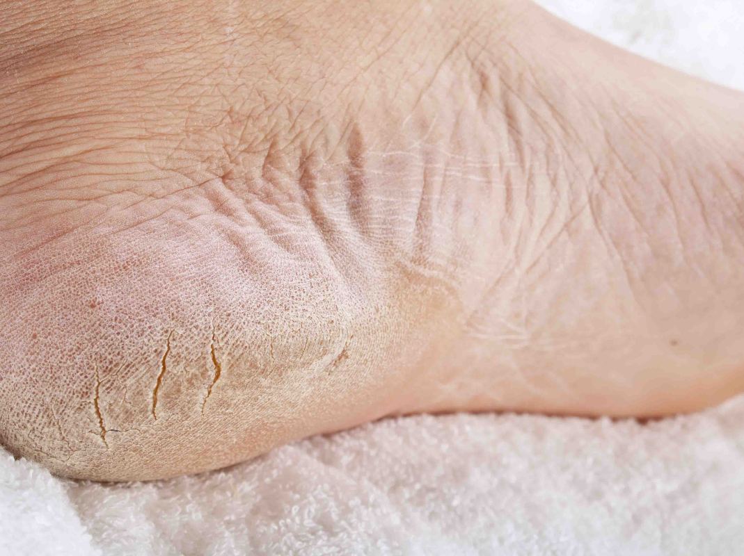При регулярном использовании соды для отпаривания и очищения стоп ног, можно избавиться даже от трещин на пятках