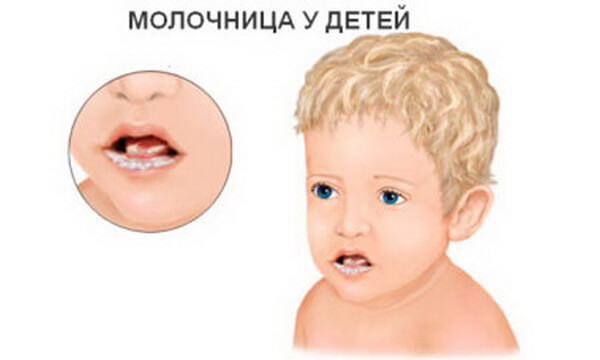 Почему возникает молочница во рту у детей