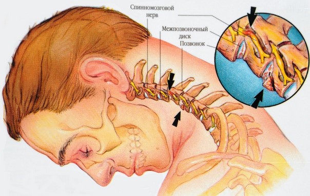 Боль в области шеи может возникнуть из-за остеохондроза