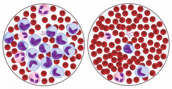 Повышены лимфоциты в крови