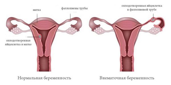 Признаки внематочной беременности на ранних сроках