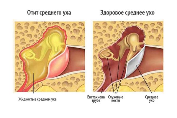 Боль в ушах может возникать при среднем отите