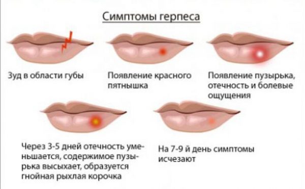 Симптомы герпеса