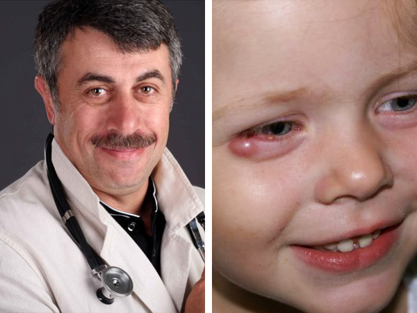 При появлении нарыва на глазу у ребенка обратитесь за помощью к лечащему врачу