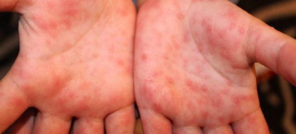 Сыпь на руках из-за вирусной инфекции