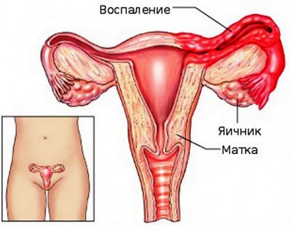 Воспаление яичников у женщин