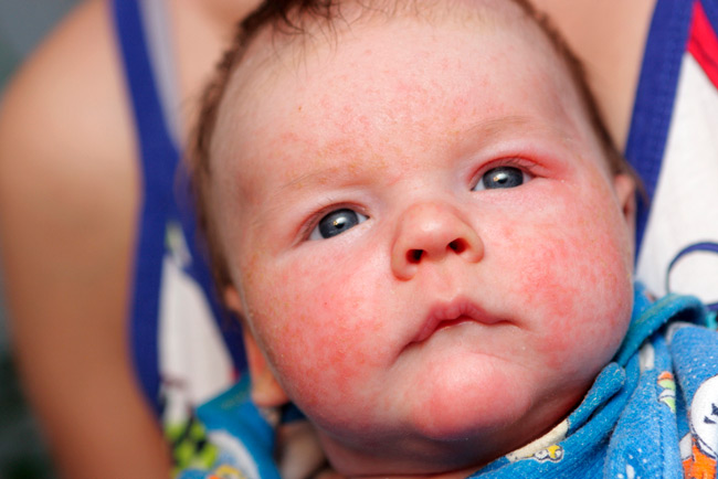 Себорейный дерматит у ребенка на лице, фото