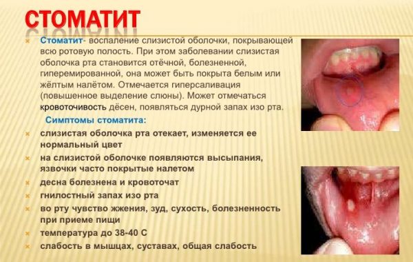 Стоматит во рту у взрослых