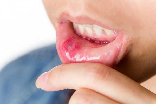Язвочки во рту могут возникать из-за неправильной гигиены