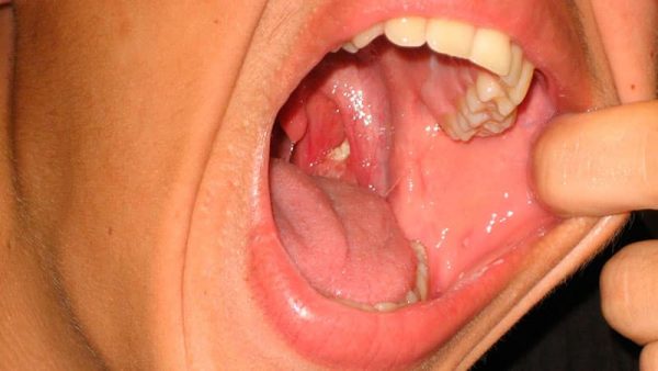 Чтобы избежать язвочек во рту регулярно посещайте стоматолога