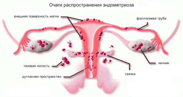 Как распространяется эндометриоз