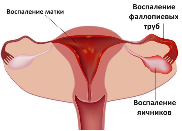 Эндометрит у женщин