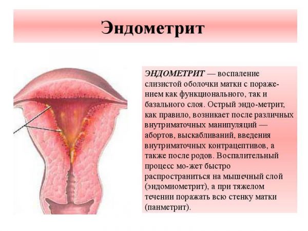 Что такое эндометрит