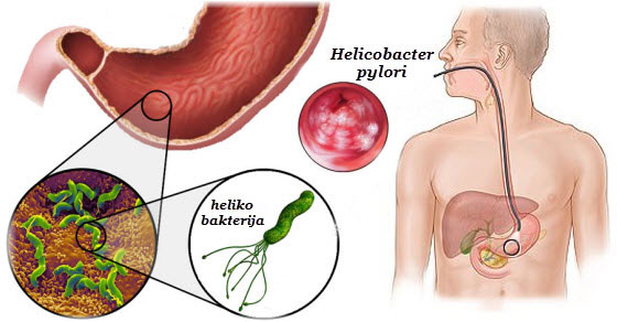 helicobacter-diagnostika-v-germanii-wb