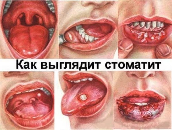 Стоматит на языке
