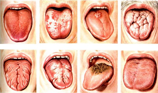 Разновидности заболеваний языка