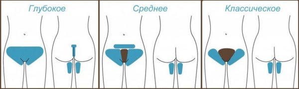 Виды эпиляции зоны бикини