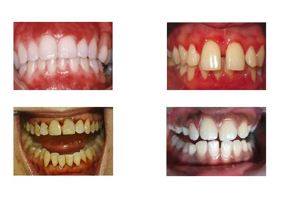 Формы гингивита на зубах