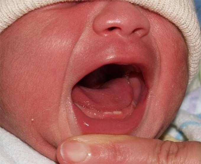 У ребенка 2, 3, 4 месяцев может появиться первый зуб.