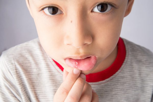 Стоматит у детей лечение 2 года комаровский
