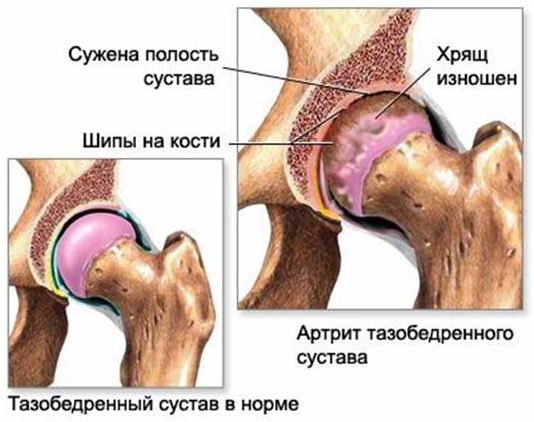 Коксоартроз тазобедренного сустава