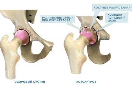 Пораженные суставы при коксоартрозе