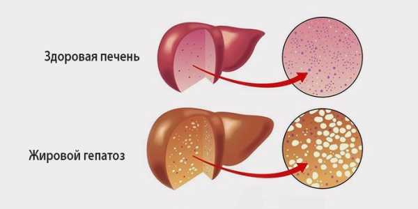 Здоровая печень и ге