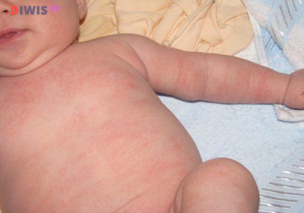 Все про аллергический диатез у детей