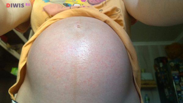 Как влияет крапивница во время беременности на плод