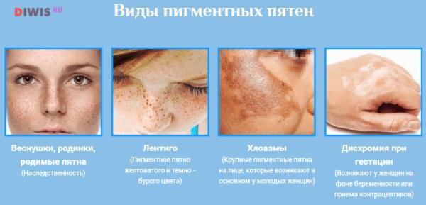 Как избавиться от пигментации кожи лица