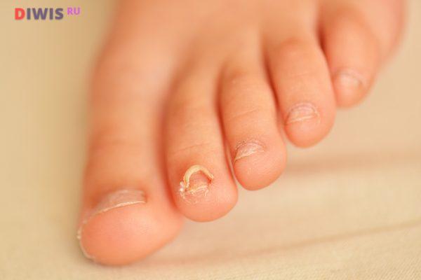 Как лечить грибок ногтей на ногах уксусом и яйцом?