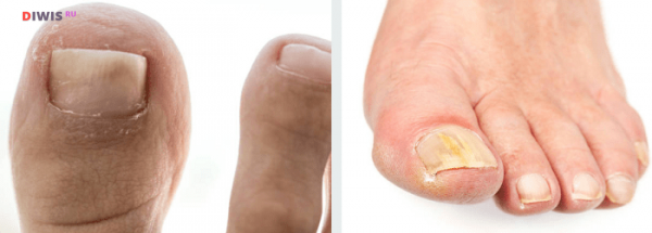 Как лечить грибок ногтей на ногах уксусом и яйцом?