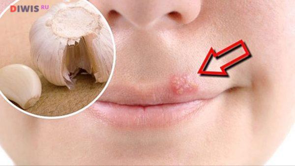 Как быстро вылечить простуду на губах