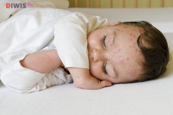 Каковы симптомы и лечение энтеровирусной инфекции у ребенка