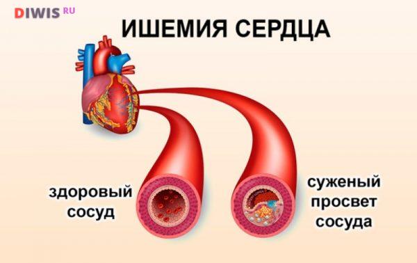 Как распознать симптомы ишемической болезни сердца у мужчин