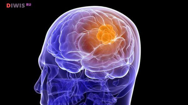 Симптомы опухоли головного мозга на ранних стадиях у взрослого