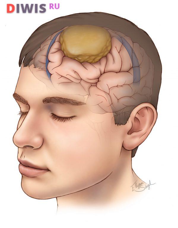 Симптомы опухоли головного мозга на ранних стадиях у взрослого