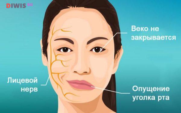 Воспаление лицевого нерва: симптомы и лечение в домашних условиях (фото)