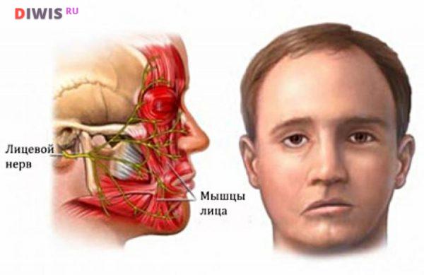 Симптомы и лечение воспаления лицевого нерва